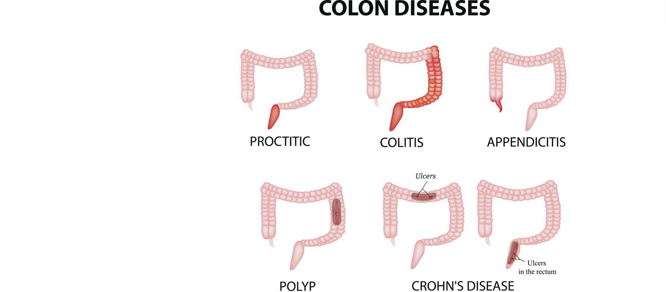 Νόσος Crohn
