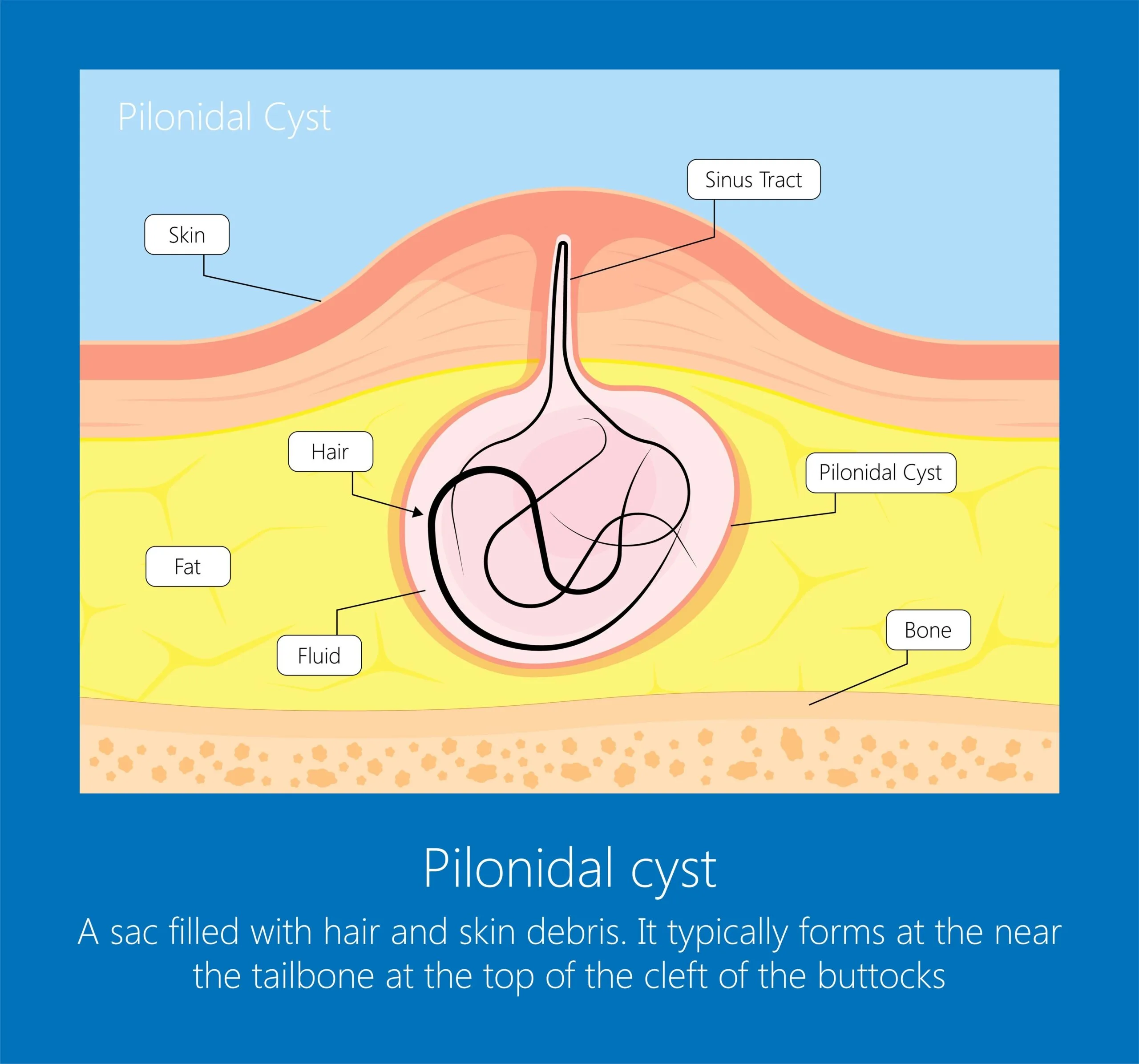 Pilonidal Cyst Diagram Ursache Und Entstehung Stei beinfistel Pilonidal Cyst Diagram Ursache Und Entstehung Stei beinfistel