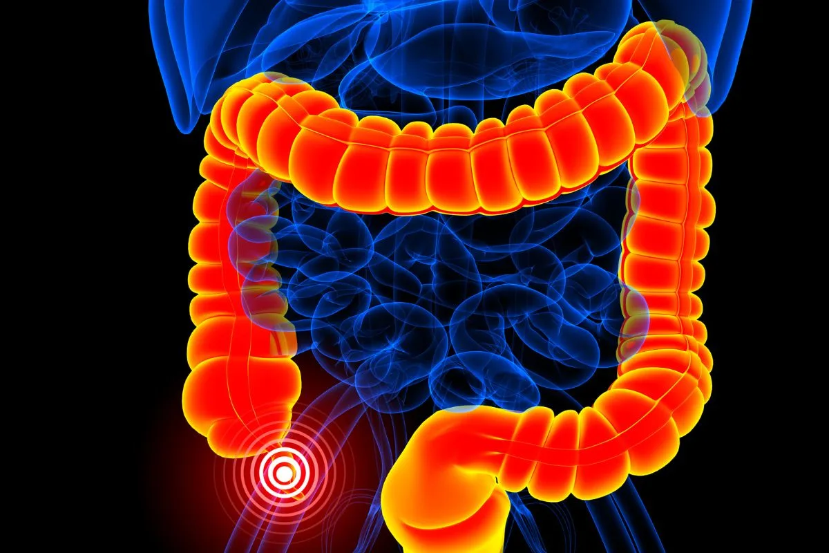 appendicitis
