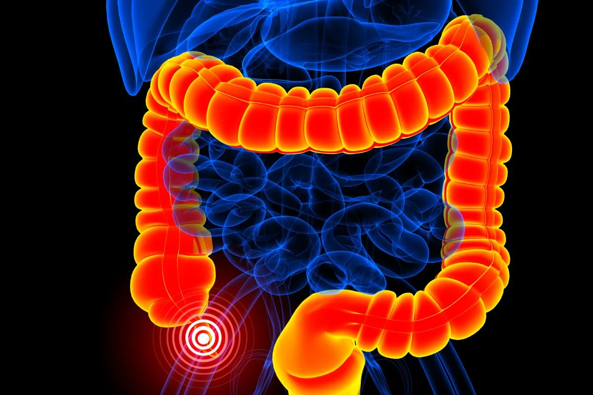 appendicitis